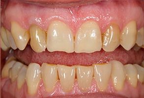 Bright Smile Dental Care, LTD | Ceramic Crowns, Extractions and All-on-4 reg 